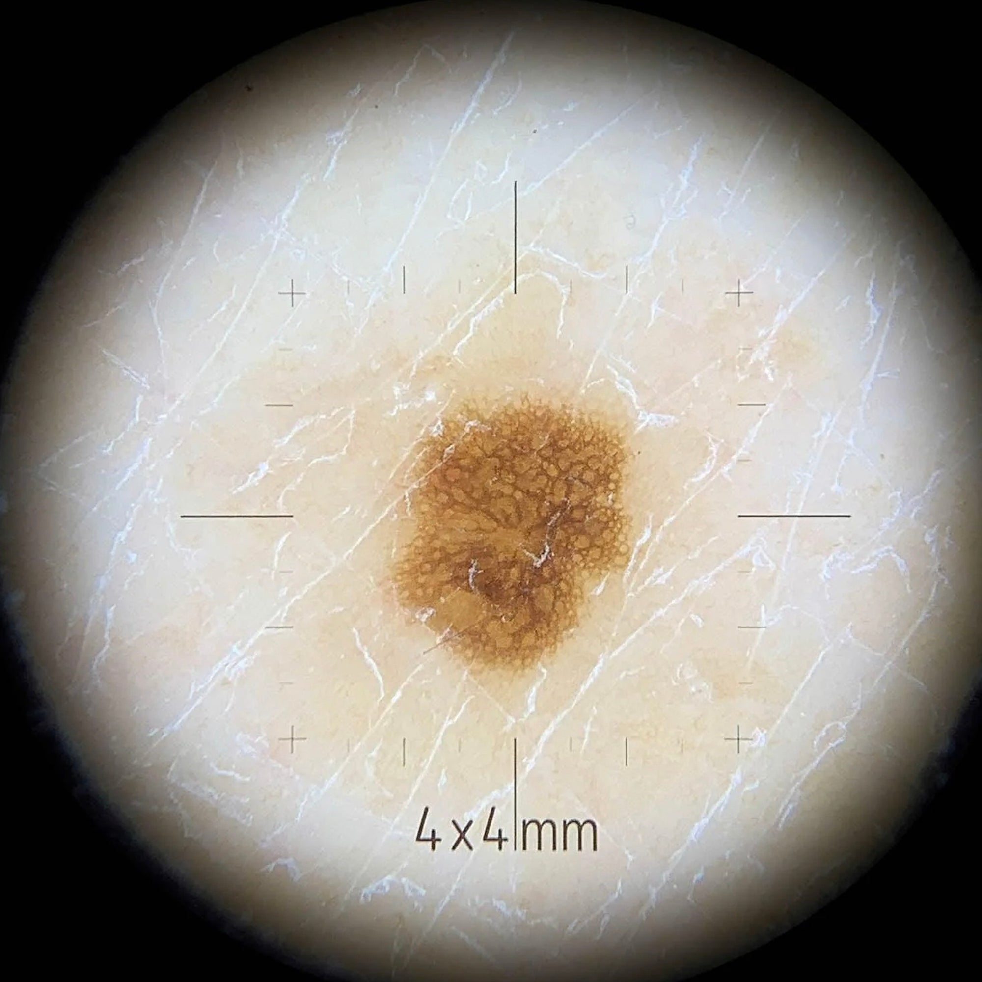 DermLite® Contact Plate for DL4™ Dermatoscope, DL4SCP