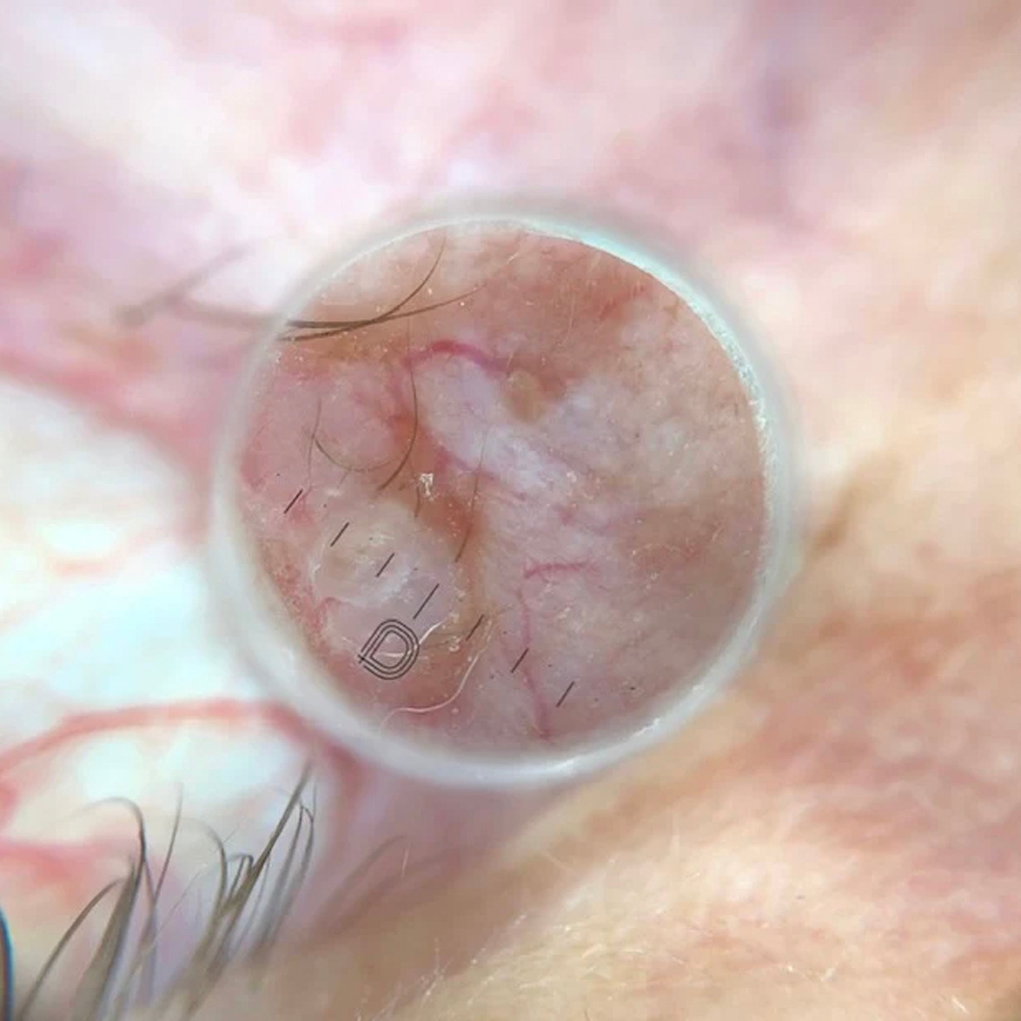 Dermlite DL5 Contact Plate - DL5-SCP